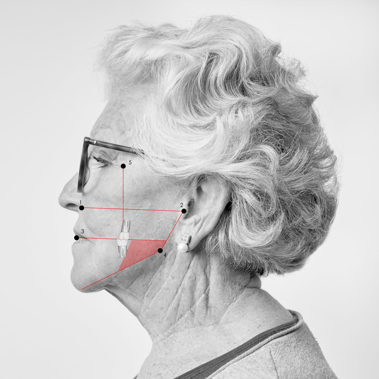 Seitliche Gesichtsanalyse einer weiblichen Patientin der wenig Höhe verträgt