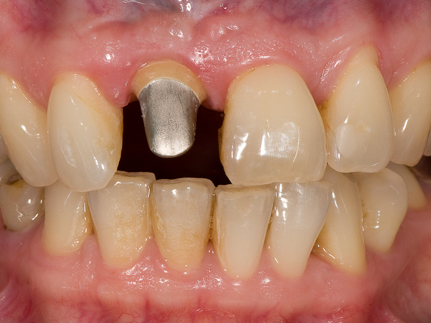 Implantatabutment im Mund