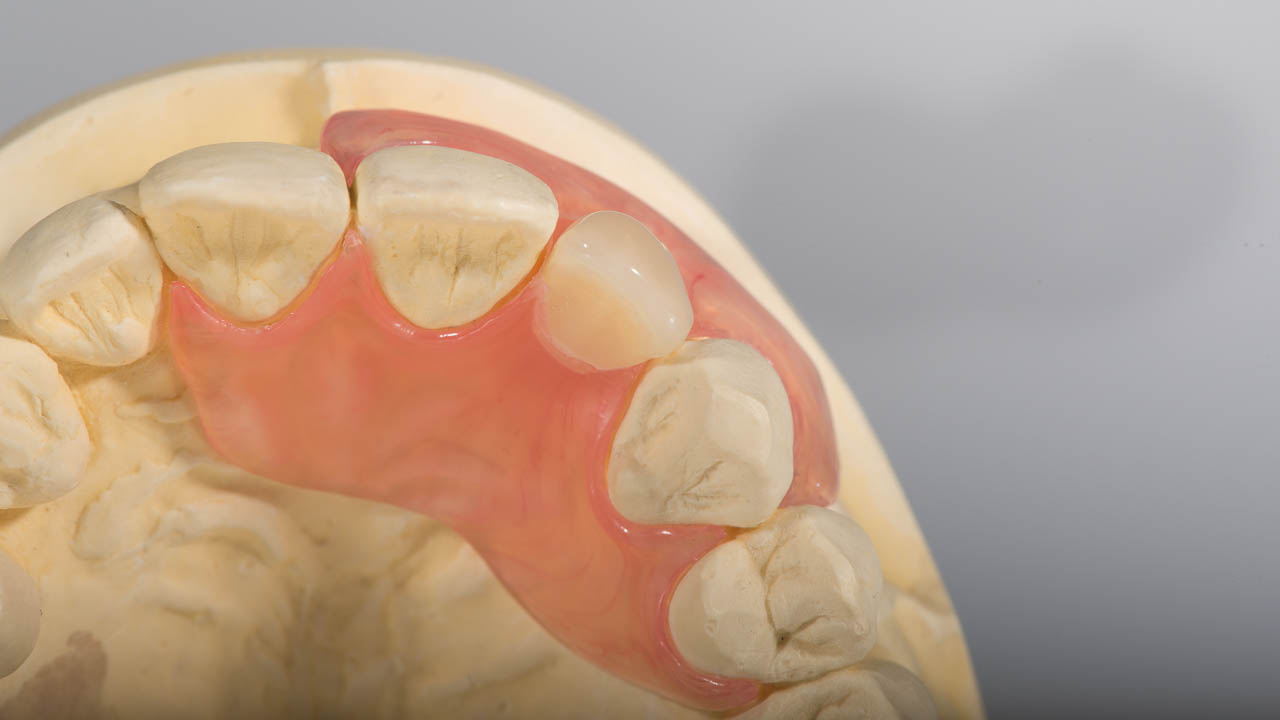 Provisorische Prothese zum Esatz von einem Zahn
