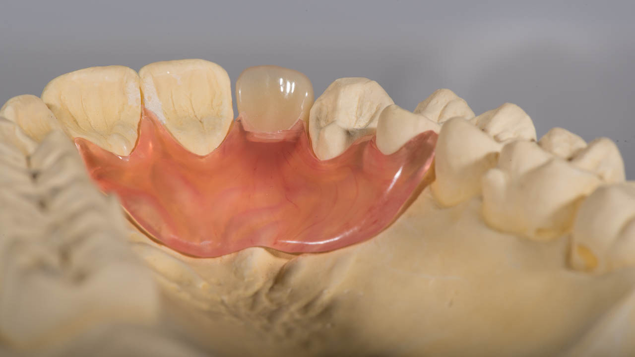 Provisorische Prothese zum Esatz von einem Zahne