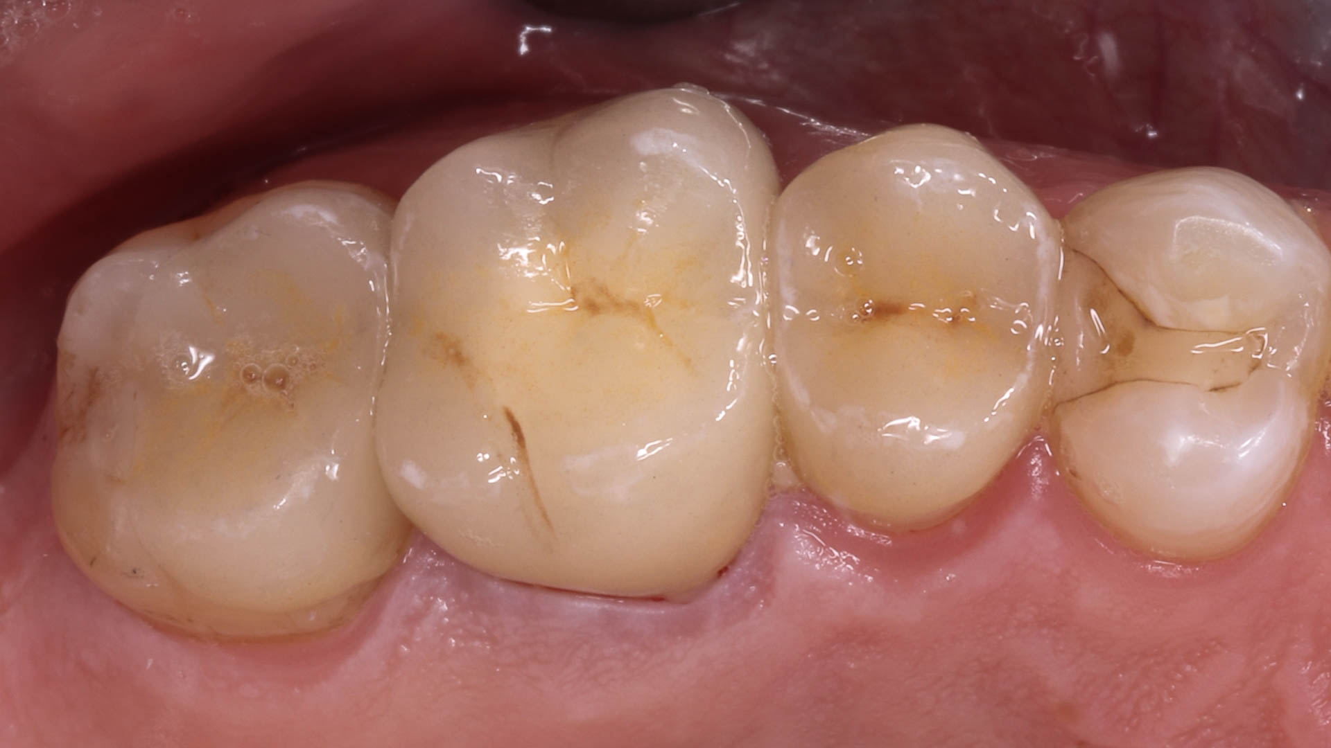 Teilkronen aus Presskeramik im Mund mit den Zähnen verklebt