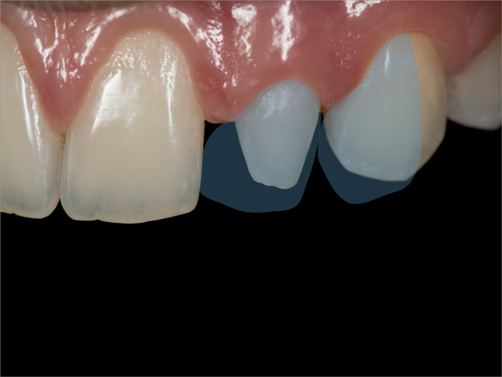 grafische Darstellung für die Versorgung von 2 Zähnen