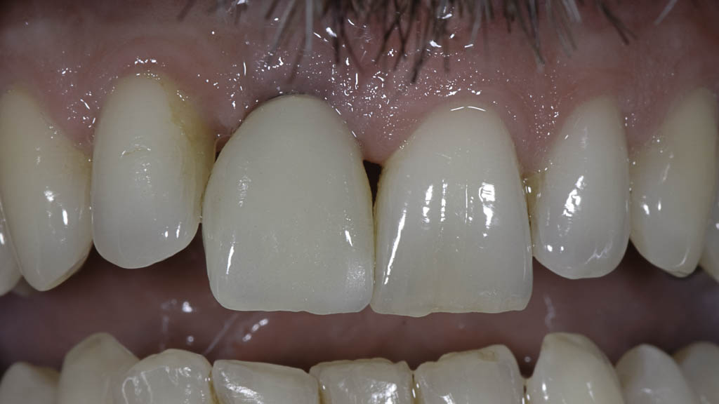 missratene Implantatversorgung - nicht stimmigen Zahnform