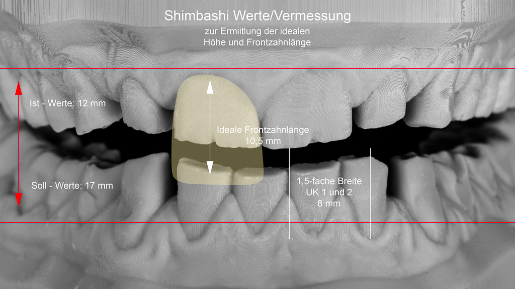 Ermittlung der dentalen Dimensionen nach Shimbashi