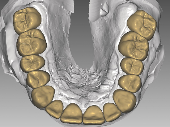 digitale Planung der neuen Zähne im Oberkiefer
