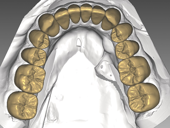 digitale Planung der neuen Zähne im Unterkiefer