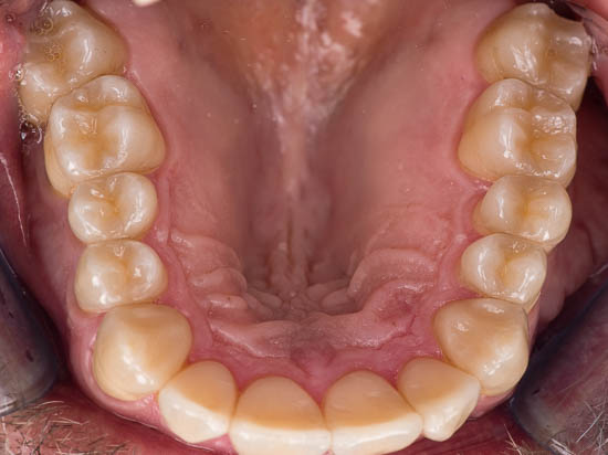 Vollkeramische Teilkronen