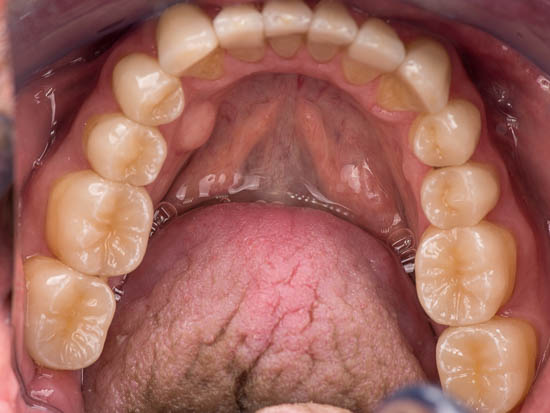 Vollkeramische Teilkronen