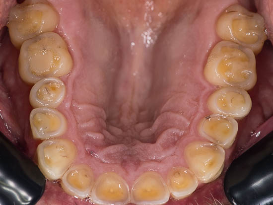 Oberkiefer - Zähne vor Behandlungsbeginn